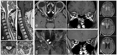 Diagnosis and Treatment of NMO Spectrum Disorder and MOG-Encephalomyelitis